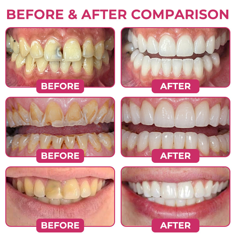 Solutiover® DenPerm Enamel Repair Gel – Helps Strengthen Enamel & Reduce Tooth Sensitivity