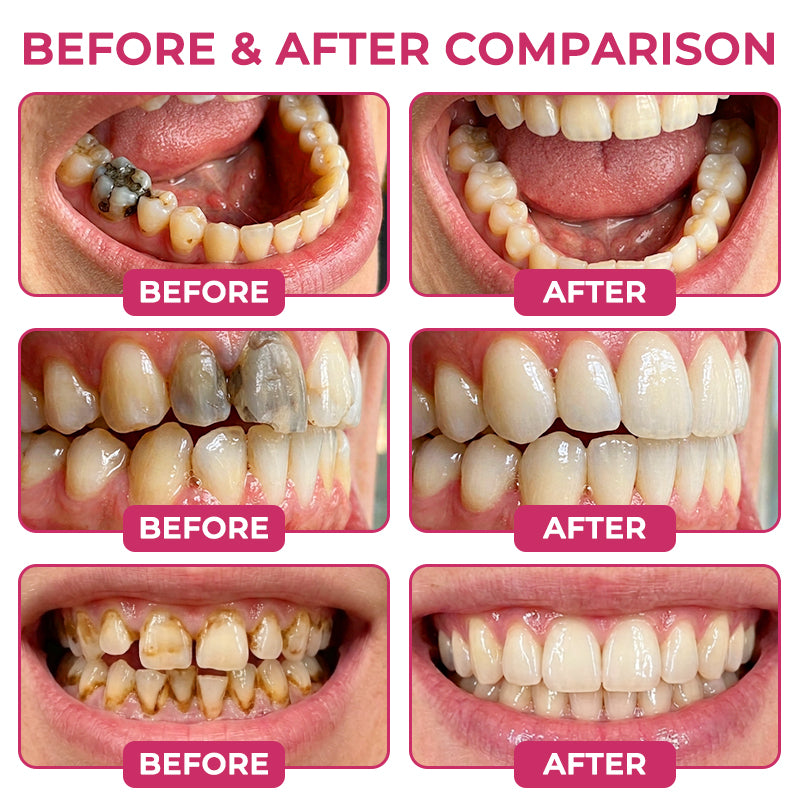 Solutiover® DenPerm Enamel Repair Gel – Helps Strengthen Enamel & Reduce Tooth Sensitivity